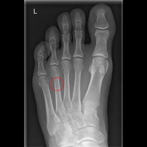 Ermüdungsbruch Stressfraktur dumpfer Schmerz Fuß Mittelfuß